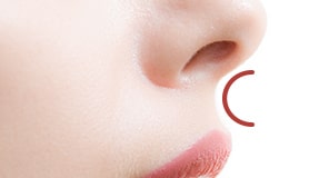 TAC式 Cカール形成